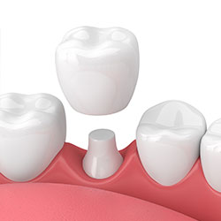 How a General Dentist Uses Crowns to Repair Teeth